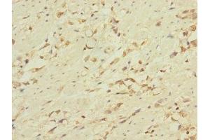 Immunohistochemistry of paraffin-embedded human gastric cancer using ABIN7158286 at dilution of 1:100 (CD53 anticorps  (AA 100-180))