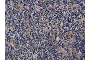 Immunohistochemical staining of paraffin-embedded Human lymphoma tissue using anti-ARHGAP25 mouse monoclonal antibody. (ARHGAP25 anticorps)