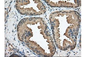 Immunohistochemical staining of paraffin-embedded Adenocarcinoma of Human ovary tissue using anti-BCL10 mouse monoclonal antibody. (BCL10 anticorps)