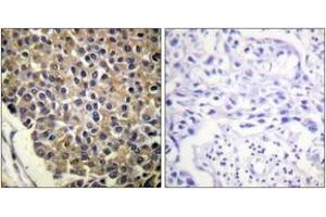 Immunohistochemistry analysis of paraffin-embedded human breast carcinoma, using IL-8R beta/CDw128 beta (Phospho-Ser347) Antibody. (CXCR2 anticorps  (pSer347))