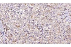 ABIN6273333 at 1/100 staining Human thyroid cancer tissue by IHC-P. (TRAPPC9 anticorps  (Internal Region))