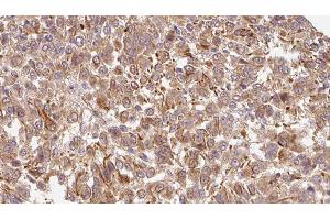 ABIN6278211 at 1/100 staining Human Melanoma tissue by IHC-P.