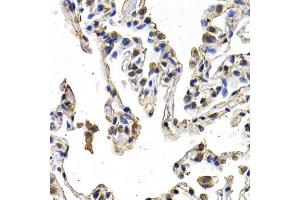 Immunohistochemistry of paraffin-embedded human lung cancer using VEGFD antibody (ABIN5970538) at dilution of 1/200 (40x lens). (VEGFD anticorps)