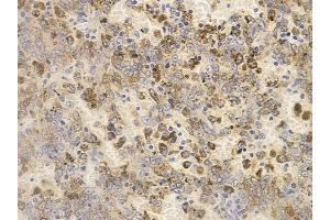 ABIN6256218 and ABIN6267659 at 1/100 staining human melanoma by IHC-P.