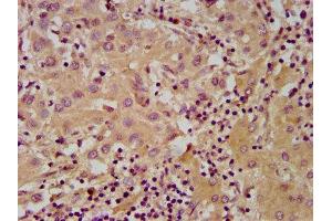 IHC image of ABIN7143530 diluted at 1:600 and staining in paraffin-embedded human liver cancer performed on a Leica BondTM system. (NUDT5 anticorps  (AA 34-166))