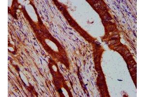 IHC image of ABIN7169209 diluted at 1:400 and staining in paraffin-embedded human colon cancer performed on a Leica BondTM system. (ULK2 anticorps  (AA 211-276))