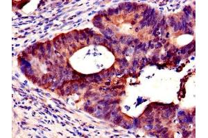 Immunohistochemistry of paraffin-embedded human colon cancer using ABIN7161940 at dilution of 1:100 (NXF5 anticorps  (AA 1-200))