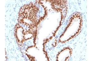 Formalin-fixed, paraffin-embedded human Prostate Carcinoma stained with NKX3. (NKX3-1 anticorps  (AA 92-224))