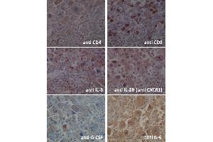 Immunohistological staining of the cancer lesion (x400). (CXCR1 anticorps  (C-Term))
