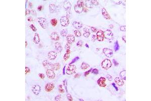Immunohistochemical analysis of Cyclin G1 staining in human lung cancer formalin fixed paraffin embedded tissue section. (Cyclin G1 anticorps  (Center))