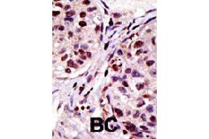 Formalin-fixed and paraffin-embedded human cancer tissue reacted with HGS polyclonal antibody  , which was peroxidase-conjugated to the secondary antibody, followed by AEC staining . (HGS anticorps  (N-Term))