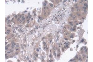 Detection of RGN in Human Liver cancer Tissue using Polyclonal Antibody to Regucalcin (RGN)