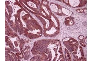Immunohistochemistry of humen colon cancer with LARS polyclonal antibody .