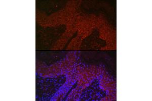 Immunofluorescence analysis of human skin cancer using DKK2 Rabbit pAb (ABIN7266756) at dilution of 1:400 (40x lens).