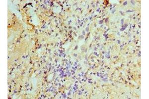 Immunohistochemistry of paraffin-embedded human lung cancer using ABIN7170632 at dilution of 1:100 (U2AF1 anticorps  (AA 1-240))