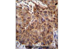 SNX24 Antibody immunohistochemistry analysis in formalin fixed and paraffin embedded human breast carcinoma followed by peroxidase conjugation of the secondary antibody and DAB staining.