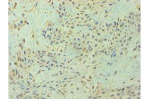 Immunohistochemistry of paraffin-embedded human breast cancer using ABIN7154586 at dilution of 1:100