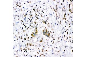 Anti- NR3C1 antibody,IHC(P) IHC(P): Human Mammary Cancer Tissue (Glucocorticoid Receptor anticorps  (AA 1-373))