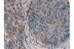 Detection of b2M in Human Esophagus cancer Tissue using Polyclonal Antibody to Beta-2-Microglobulin (b2M)