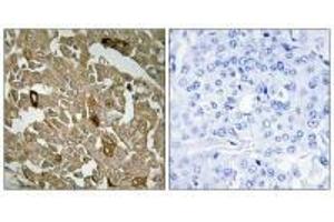 Immunohistochemistry analysis of paraffin-embedded human breast carcinoma tissue, using BTBD6 antibody. (BTBD6 anticorps)