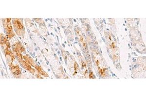 Immunohistochemistry of paraffin-embedded Human gastric cancer tissue using NDUFB7 Polyclonal Antibody at dilution of 1:35(x200) (NDUFB7 anticorps)