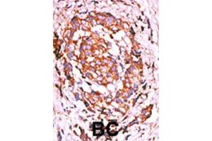 Formalin-fixed and paraffin-embedded human breast cancer tissue reacted with ERBB2 (phospho Y1248) polyclonal antibody  which was peroxidase-conjugated to the secondary antibody followed by AEC staining. (ErbB2/Her2 anticorps  (pTyr1248))