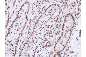 Immunohistochemical staining of paraffin-embedded A549 xenograft using Progesterone receptor antibody at a dilution of 1:100