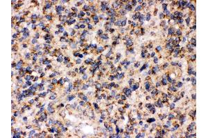 Anti- FE65 Picoband antibody, IHC(P) IHC(P): Human Glioma Tissue