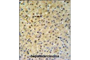 PSME1 Antibody IHC analysis in formalin fixed and paraffin embedded hepatocarcinoma followed by peroxidase conjugation of the secondary antibody and DAB staining. (PSME1 anticorps  (C-Term))