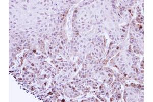 IHC-P Image Immunohistochemical analysis of paraffin-embedded Cal27 xenograft, using TACC2, antibody at 1:100 dilution. (TACC2 anticorps  (N-Term))
