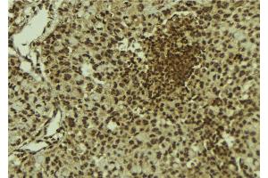 ABIN6278768 at 1/100 staining Human breast cancer tissue by IHC-P. (KAT6B anticorps  (C-Term))