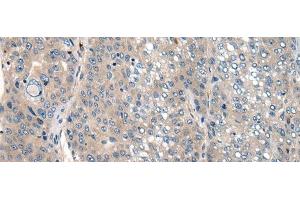 Immunohistochemistry of paraffin-embedded Human liver cancer tissue using CLTCL1 Polyclonal Antibody at dilution of 1:60(x200) (CLTCL1 anticorps)