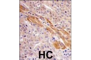 Formalin-fixed and paraffin-embedded human hepatocarcinoma tissue reacted with PGK1 Antibody (Center ) (ABIN391250 and ABIN2837966) , which was peroxidase-conjugated to the secondary antibody, followed by DAB staining. (PGK1 anticorps  (AA 305-334))