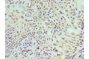 Immunohistochemistry of paraffin-embedded human breast cancer using ABIN7150341 at dilution of 1:100 (MCM7 anticorps  (AA 360-719))