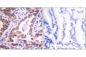 Immunohistochemistry analysis of paraffin-embedded human lung carcinoma tissue, using Calnexin (Ab-583) Antibody. (Calnexin anticorps  (AA 543-592))