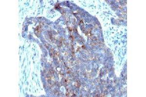 Formalin-fixed, paraffin-embedded human ovarian carcinoma stained with RBP1 (RBP/872) (RBP1 anticorps)