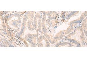 Immunohistochemistry of paraffin-embedded Human thyroid cancer tissue using SEPT10 Polyclonal Antibody at dilution of 1:25(x200) (Septin 10 anticorps)