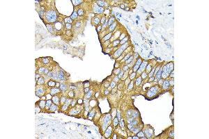 Immunohistochemistry of paraffin-embedded human liver cancer using SLC22/OCT3 Rabbit mAb (ABIN7269107) at dilution of 1:100 (40x lens). (SLC22A3 anticorps)