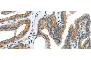 Immunohistochemistry of paraffin-embedded Human thyroid cancer using VAMP2 Polyclonal Antibody at dilution of 1/40 (VAMP2 anticorps)