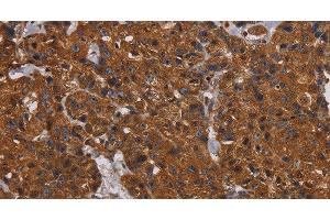 Immunohistochemistry of paraffin-embedded Human breast cancer tissue using HYAL2 Polyclonal Antibody at dilution 1:60 (HYAL2 anticorps)