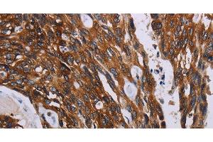 Immunohistochemistry of paraffin-embedded Human colon cancer using KARS Polyclonal Antibody at dilution of 1:60 (KARS anticorps)