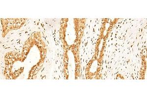 Immunohistochemistry of paraffin-embedded Human breast cancer tissue using ZNF471 Polyclonal Antibody at dilution of 1:50(x200) (ZNF471 anticorps)