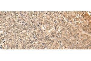 Immunohistochemistry of paraffin-embedded Human liver cancer tissue using BRF2 Polyclonal Antibody at dilution of 1:40(x200) (BRF2 anticorps)