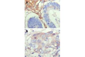 Immunohistochemical analysis of paraffin-embedded human colon cancer (A) and breast cancer (B) showing cytoplasmic localization with DAB staining using FBLN5 monoclonal antibody, clone 1G6A4 . (Fibulin 5 anticorps)