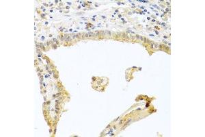 Immunohistochemistry of paraffin-embedded human lung cancer using PRKCA antibody. (PKC alpha anticorps  (C-Term))