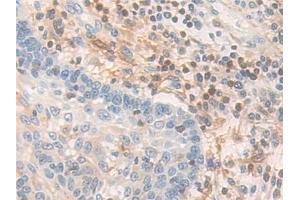 Detection of PDXK in Human Skin cancer Tissue using Polyclonal Antibody to Pyridoxal Kinase (PDXK)