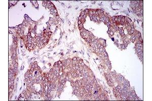 Immunohistochemical analysis of paraffin-embedded ovarian cancer tissues using HAS2 mouse mAb with DAB staining.