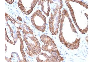 Formalin-fixed, paraffin-embedded human Prostate Carcinoma stained with EpCAM Rabbit Recombinant Monoclonal Antibody (EGP40/2571R). (Recombinant EpCAM anticorps  (Extracellular Domain))
