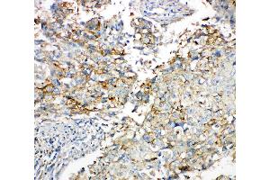 Anti-Connexin 43/GJA1 antibody, IHC(P): Human Lung Cancer Tissue