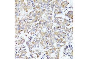 Immunohistochemistry of paraffin-embedded human liver cancer using EIF3L antibody (ABIN6131772, ABIN6140074, ABIN6140075 and ABIN6225315) at dilution of 1:100 (40x lens). (EIF3L anticorps  (AA 1-230))